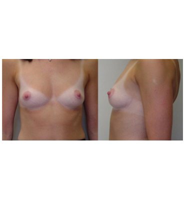 Natural Results From Breast Implant Surgery Before